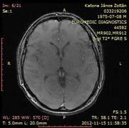 Az Idiopátiás Intracranialis Hypertónia (IIH) diagnosztikai krérium rendszereinek komplex kronológiája Friedman DI, Jacobson DM (2002). "Diagnostic criteria for idiopathic intracranial hypertension".