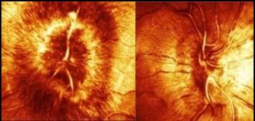 2004;35:664-670 Occluded sinuses /veins SAGGITAL SUPERIOR sinus Lateral Sinus left Lateral Sinus right Pts. No.