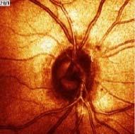 Hogyan segít a vizsgálati algoritmus azaz a differenciál diagnosztika az Intracerebrális Venous Thrombosis korai felismerésében?