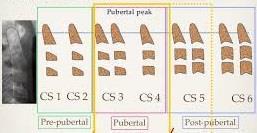 páciens 9 éves CVMS (Cervical Vertebral Maturation Stage) alapján CS3 stádium Retrognát arctípus, retrognát mandibula Angle féle osztályozás alapján Angle II/1 Az esetek