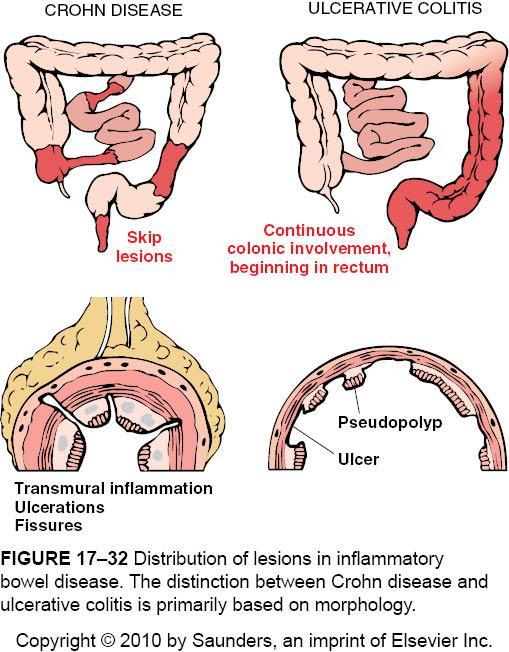 II. Inflammatory Bowel Disease (IBD) Crohn betegség (CD), Colitis ulcerosa (UC) Elkülönítés az érintett bélszakaszok és a gyulladásos
