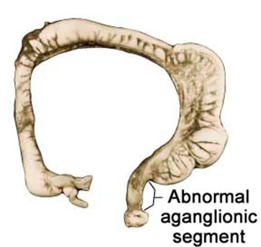 Megacolon congenitum HIRSCHPRUNG betegség (F:L=4:1) 5000 újszülöttből 1 parasympathicus ganglionok hiánya (Meissner és Auerbach plexus- nincsenek ganglion sejtek) Sporadicus vagy családi halmozódást
