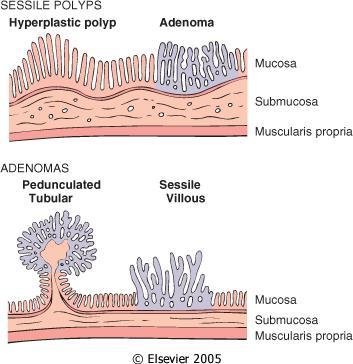 NEOPLASTICUS POLYPUSOK- Mucosalis low- és high grade neoplasia (adenomák) I.