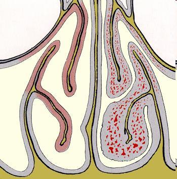 2 Egyéb betegségekben a nátha súlyosbító tényező, így a cisztás fibrózisban (CF), a diabetes mellitus esetén, immundefektusban, anatómiai eltérésekben és fibrózus dysplasiában.