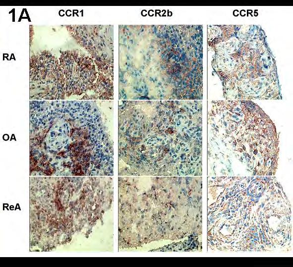 CCR expression in inflamed synovial tissue