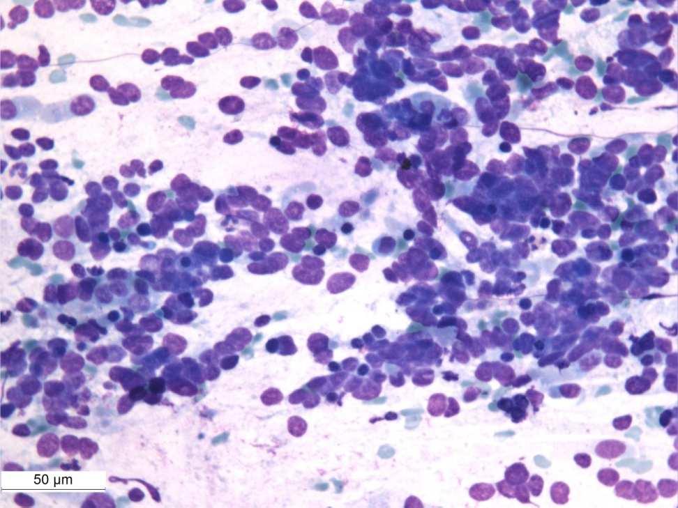 75 éves ffi, korábban nephrectomia(vesesejtes carcinoma)