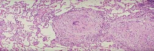 tipikusan epithelioid