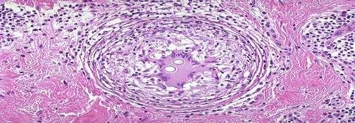 limfociták és fibroblastok