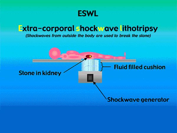 (ESWL) Vesekövek zúzása Frekvencia: 100 khz - 1 MHz, p max = 50 MPa Direkt