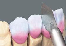 BASIC réteg Hidak esetében az első dentinégetés előtt az egyes tagokat minden esetben interdentálisan a vázig szét kell választani. Fogpótlás elkészült rétege az első dentinégetés előtt.