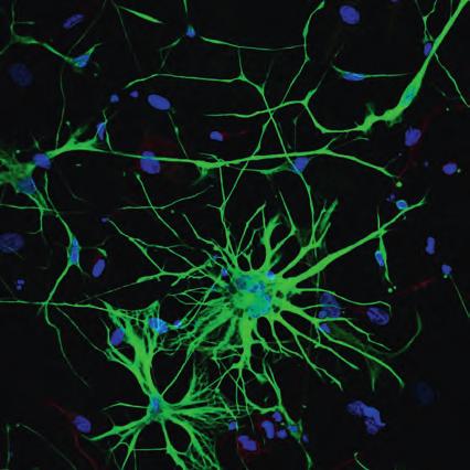 A mikrogliasejtek fokozott aktivitását az asztrocitákéval szemben korábban már többféle, az idegsejtek pusztulásával együtt járó neurodegenerációs kórkép (például a fokozott feledékenységgel együtt