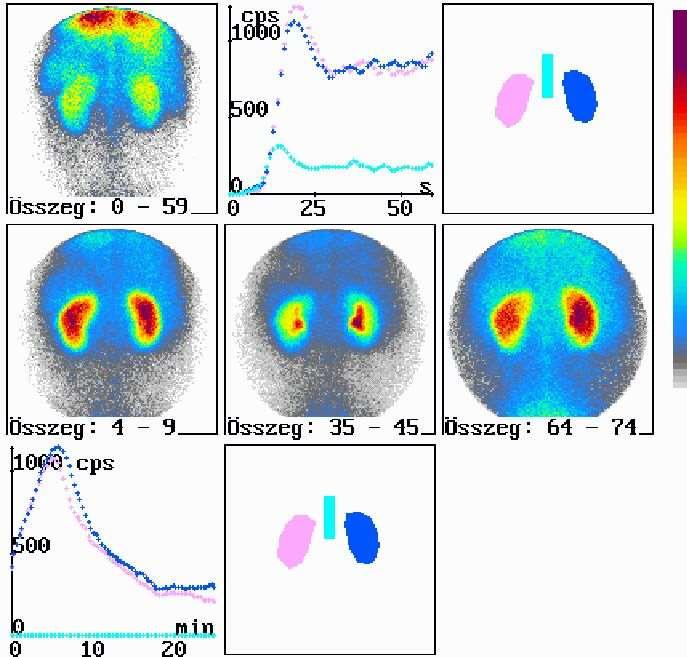 Normális veseműködés Perfúzió (1 s, 60 kép)