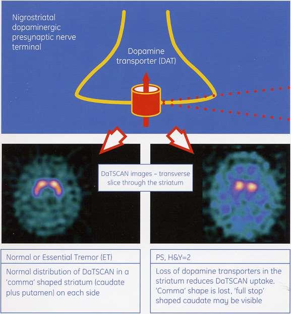 DATSCAN dopamin transporter vizsgálat Radiofarmakon: 123I-Ioflupán DATSCAN binds to the dopamine transporters (DAT), which are on the neurons in specific