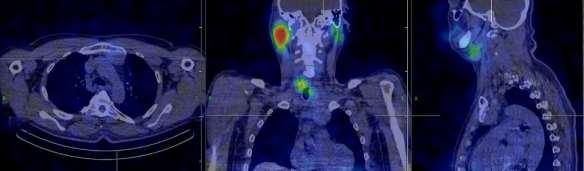 Pajzsmirigy carcinoma, jódot fel nem