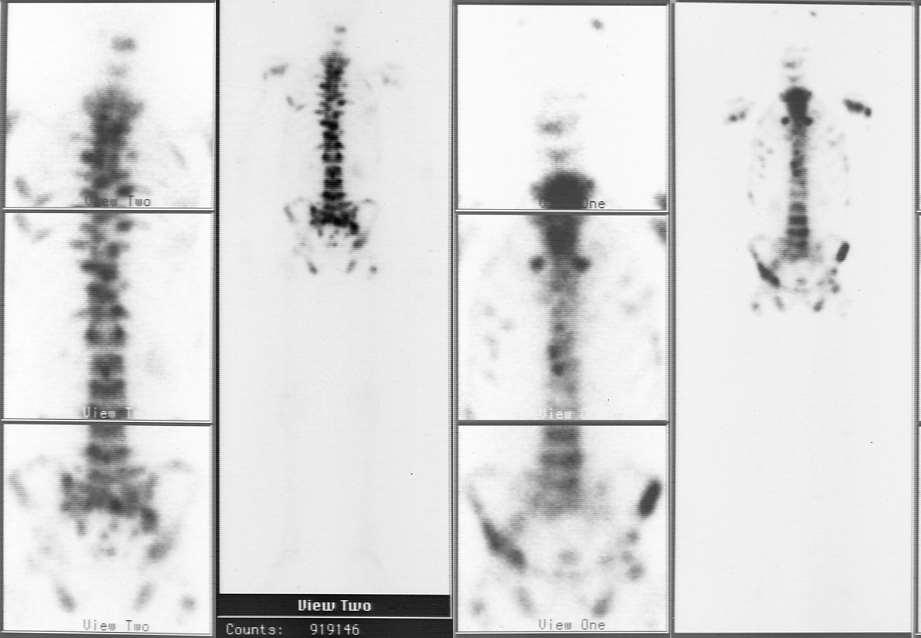 Többgócú csontmetastasis