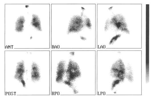 Pulmonális embolia, perfúziós-inhalációs mismatch