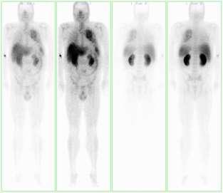 Carcinoid