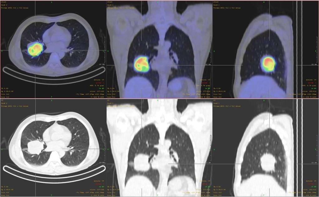 18F-FDG PET-CT vizsgálat