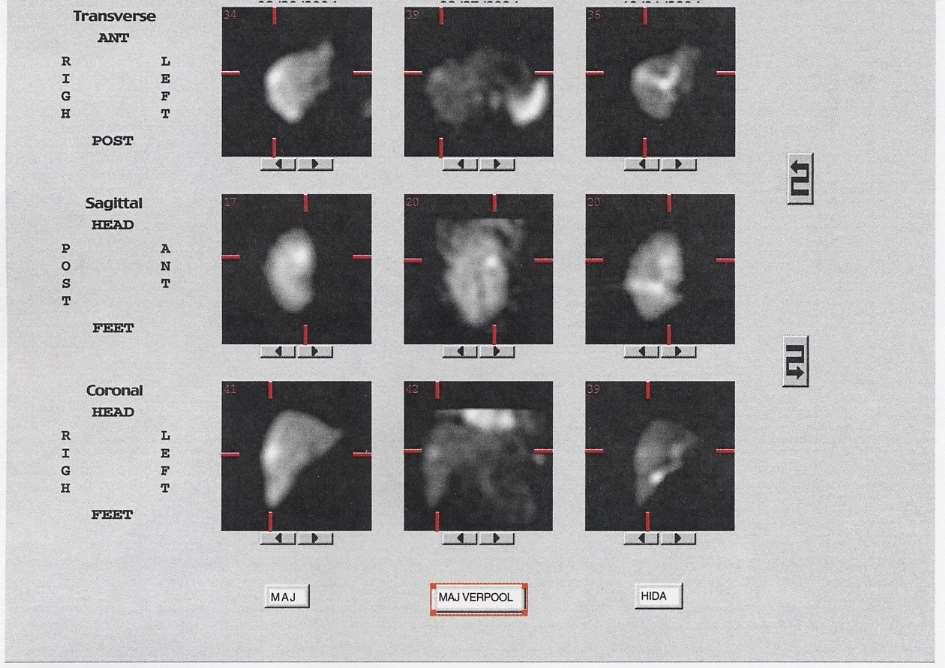 Focalis nodularis hyperplasia Speciális vizsgálati protokoll Általában: kolloid