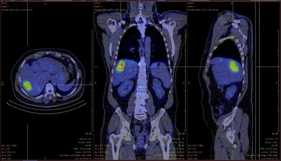 Recto-sigmoidalis carcinoma