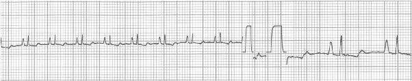 Elektrokardiográfia 1-2 fokozat: az ECG rendszerint nem mutat rendellenességeket 3fokozat: Súlyos, előrehaladott HWD esetén (a frontalis szívtengely jobbra tolódása) A jobb pitvar megnagyobbodásának