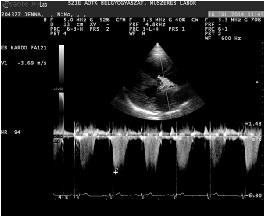 Jobb parasternalis, rövidtengelyű sík, az inhúrok/chordae tendineae (CT) szintjénél.