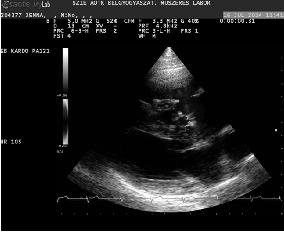 IVS LV RV LA RA Súlyos fokú tricuspidalisinsufficientia videófelvétele. Színes Doppler/color flow Doppler (CFD) felvétel.