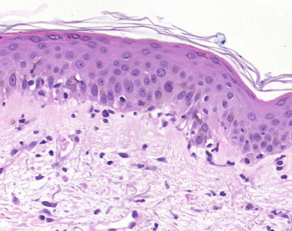 Erythema multiforme fonott orthokeratoticus str.