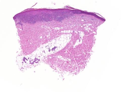 Lichen ruber planus Ortho-hyperkeratosis Acanthosis, fűrészfogszerű hámcsapok hypergranulosis (ék alakú) Apoptoticus keratinocyták