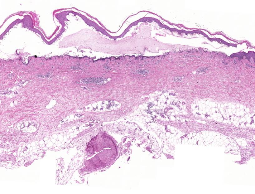 Pemphigus vulgaris Spongiosis korai elváltozásban, ritkán