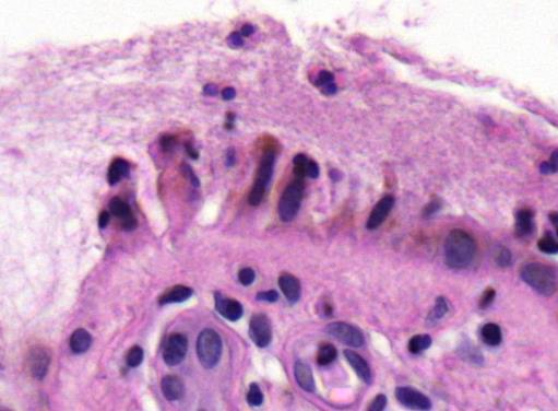 acantholysis miatt Follicularis érintettség Superficialis