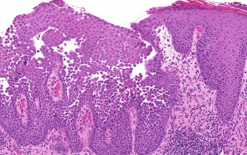 Hailey-Hailey betegség acantholysis, acanthosis-omladozó téglafalra emlékeztető kép adnexalis érintettség