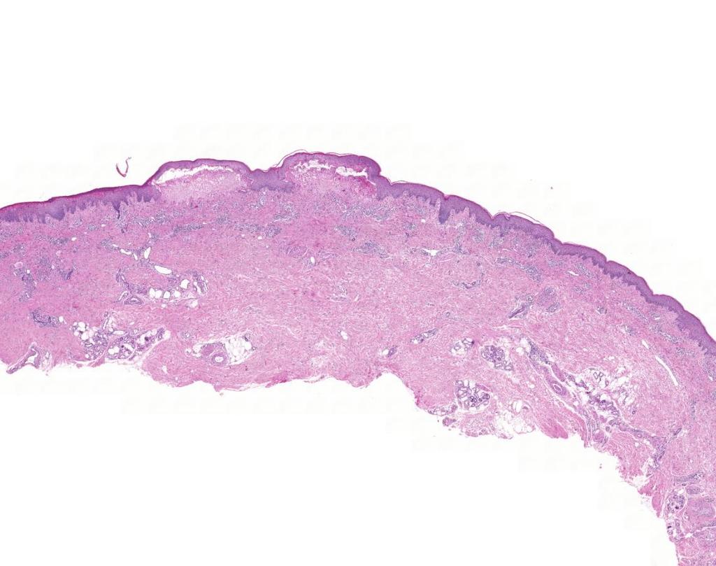 Bullosus pemphigoid subepidermalis vesicula/bulla eosinophilekkel