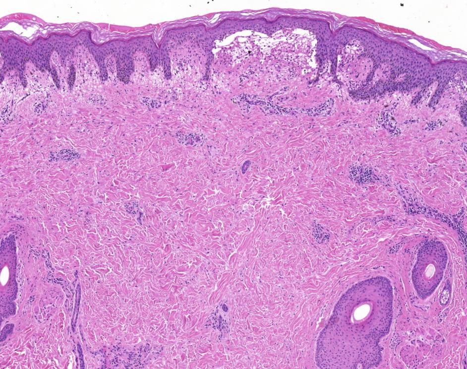 DHD szöveti jellemzői Subepidermalis hólyag Neutrophil gazdag infiltratum a hólyagűrben és a dermisben