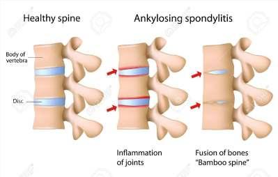 Spondylitis ankylopoetica Krónikus, progresszív gyulladásos ízületi betegség Fiatal felnőttkorban kezdődik,