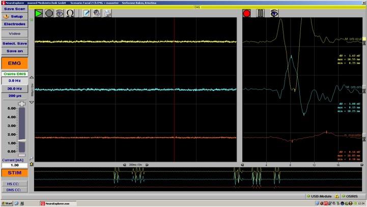 2. ábra: n. facialis monitorozása m. masseter csatornával (n. trigeminus) kiegészítve: egyértelmű izomválasz detektálható a n. facialis által beidegzett m. orbicularis oculi és m.