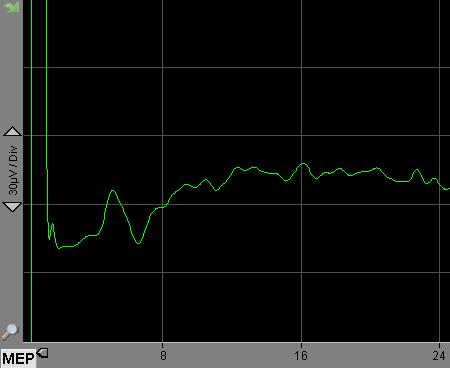 3. ábra: d-hullám regisztráció: 4,3 ms látenciával azonosítható hullám a kortikospinális pálya mentén terjedő elektromos aktivitást jelzi A változásokat természetesen a disztális elektróda területén
