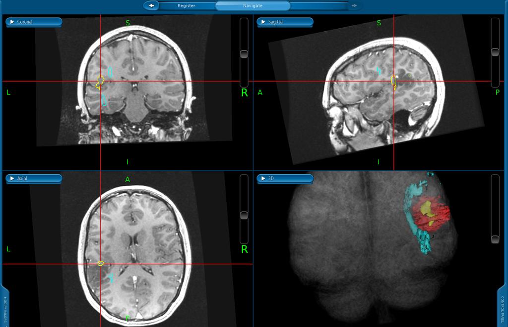 Az idegsebészeti műtétek tervezésének alappillérét jelentik a preoperatív képalkotó vizsgálatok.