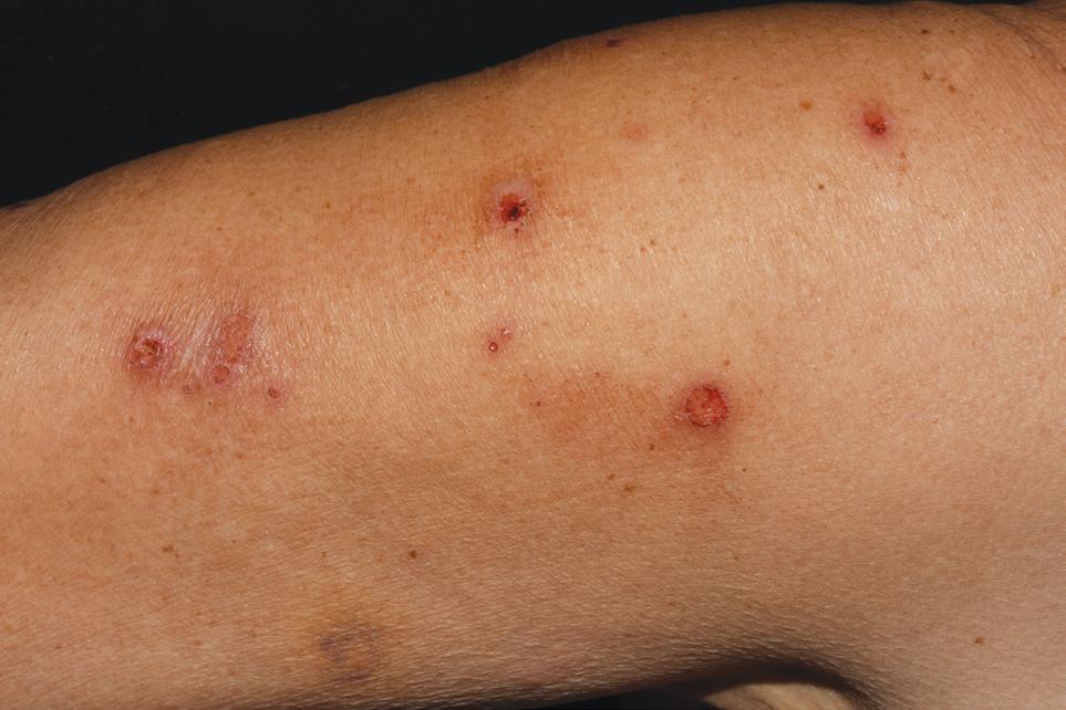 antitest titerek alapján nem merült fel a paraneoplasztikus pemphigus lehetősége, ez a betegek utánkövetése során sem igazolódott.
