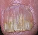 Feltétlen patogének Mycosisok felosztása ép szervezetben, szövetekben okoznak fertőzést Felületi: bőr, köröm, haj keratinizált
