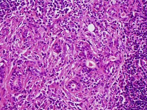 Chronicus sialoadenitis Lymphoepithelialis sialoadenitis Relatíven gyakori Chronicus lymphocytás gyulladás, gyakran tünetek nélkül Elzáródáshoz társulhat (atrophia és fibrosis), rheumatoid arthritis