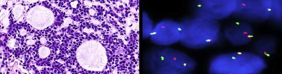 Adenoid cysticus carcinoma t(6;9) (q22 23; p23 24) MYB-NFIB