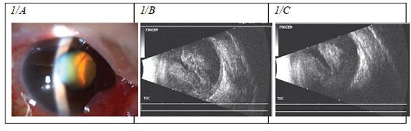 1. ábra 1/A: Réslámpás fotó az első megjelenéskor: sekély csarnok és a pupillát átvilágítva a lencse mögött hólyagszerűen előboltosuló retina látszik vörös visszfény hiányával 1/B: B-módú