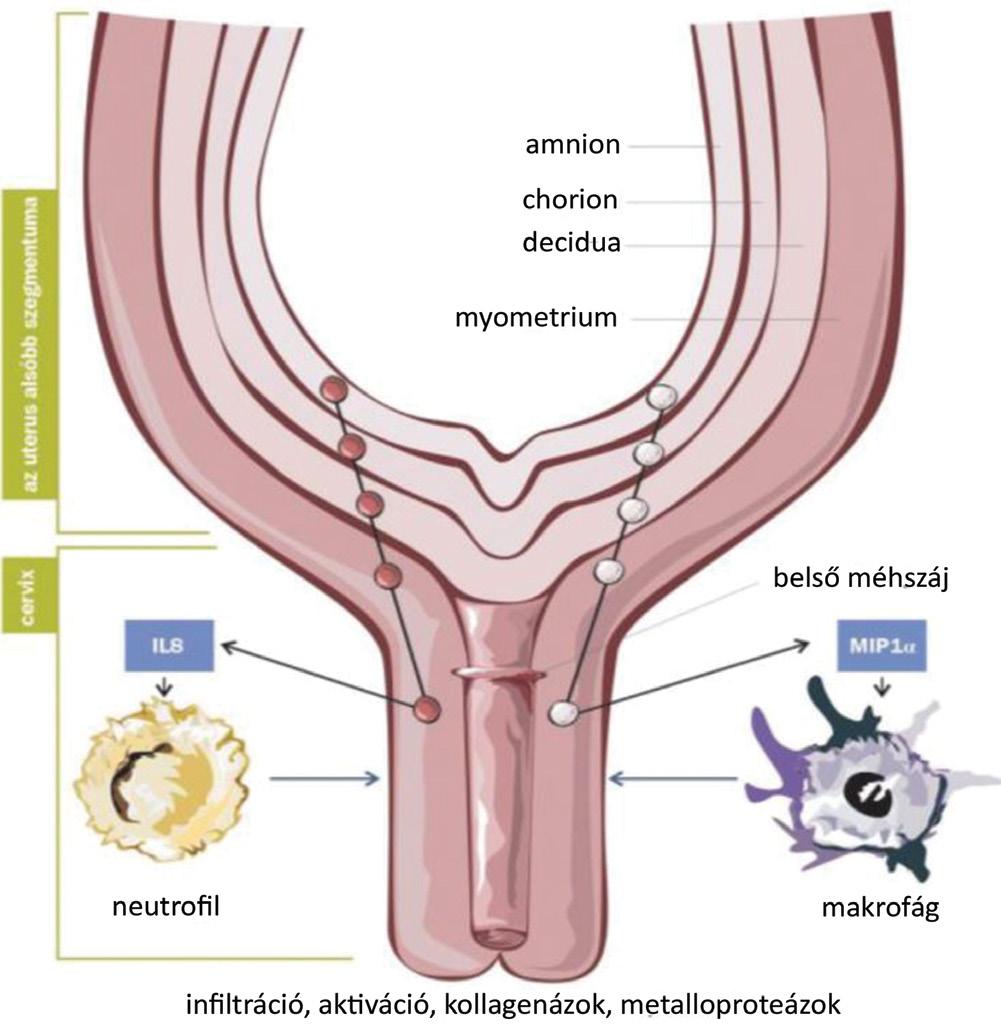 5. ábra A chemokinek feltételezhető szerepe a cervix érésében A chemokinek lehetséges forrásai és a chemokinek valószínű hatásai a cervicalis állapotra.