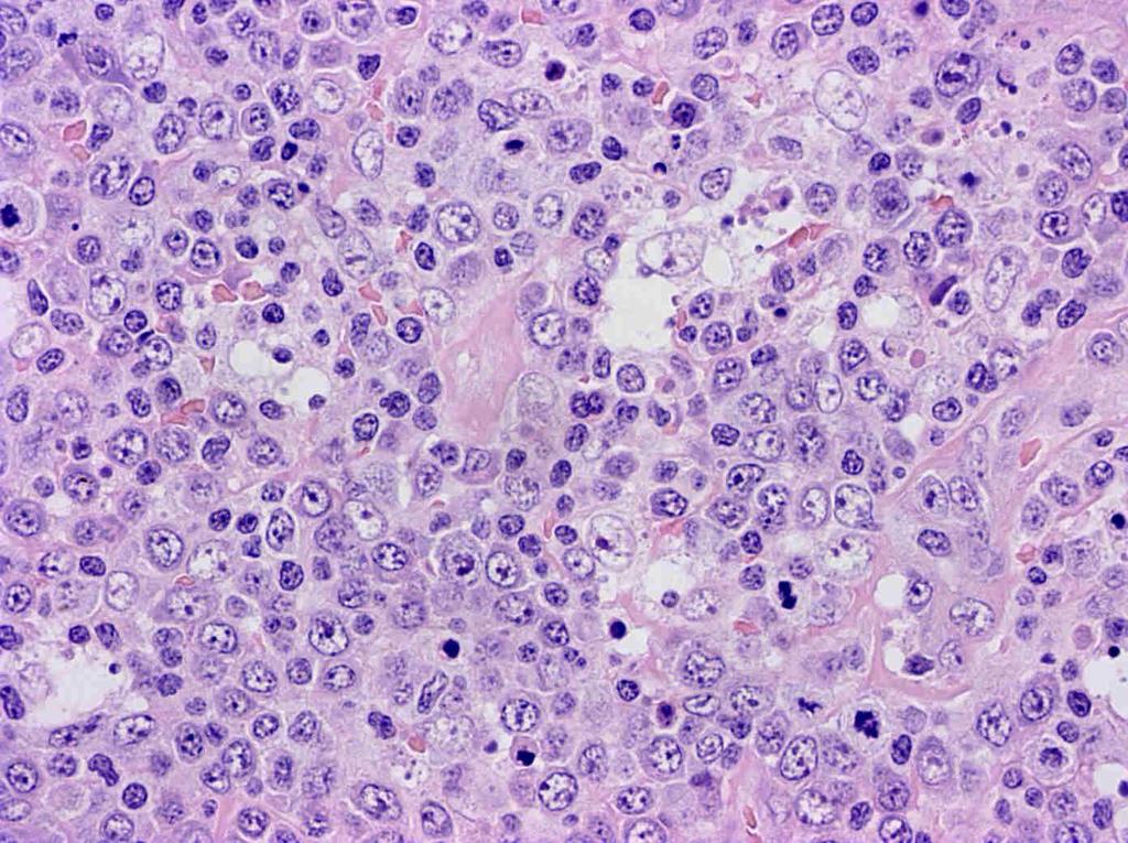 40x Mononucleosis infectiosa, paracorticalis hyperplasia