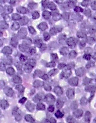 LYMPHOBLASTOS LYMPHOMA Hyperakut