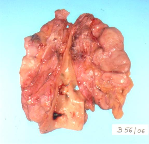 CLL / SLL >5G/L, CD5, CD23, dimcd20, CD200+ Kezdet