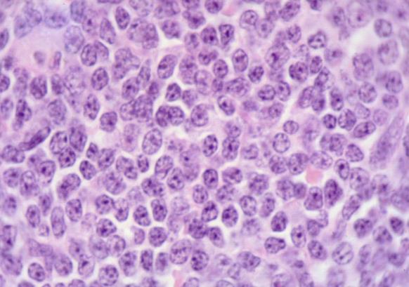 sejt) nyirokcsomó lymphoma definíció epidemiológia