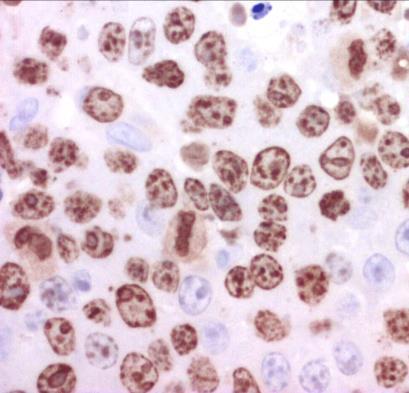 DIFFÚZ NAGY B-SEJTES LYMPHOMA High grade lymphoma Összefoglaló nagy kategória LCA+, CD 20+, CD79a+, CD 19+ Leggyakoribb lymphoma típus Több speciális altípus, ABC/CG, c-myc Nodalis és extranodalis