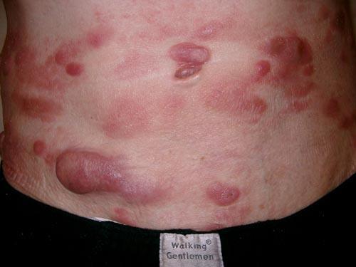 T-sejtes bőrlymphoma